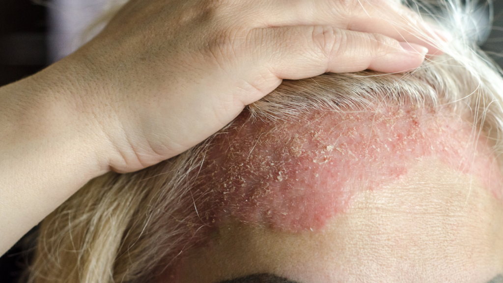 Remedies for Psoriasis