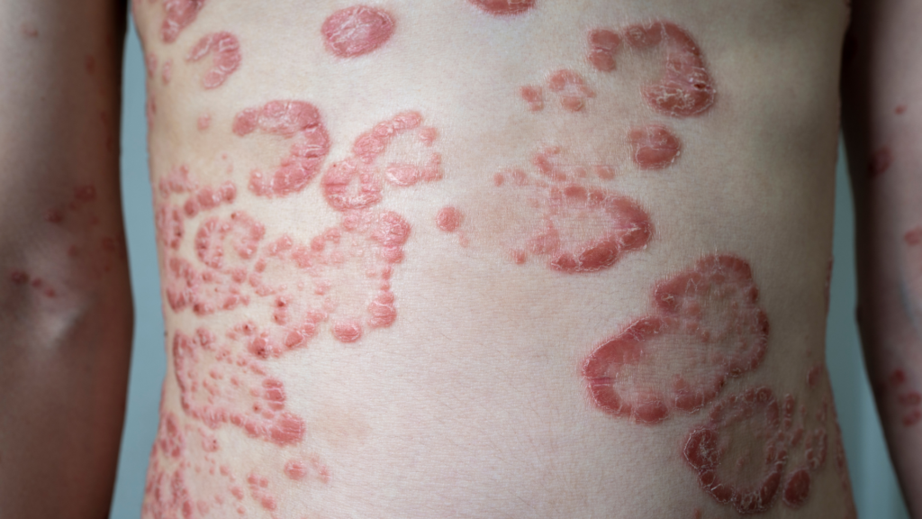  Psoriasis