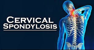 Types of Cervical Spondylosis Explained: Natural Healing Solutions