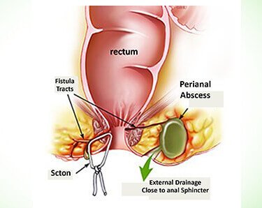 Ayurvedic fistula treatment at Sandhya Medicity