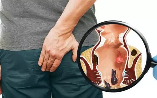 Ayurvedic piles treatment at Sandhya Medicity
