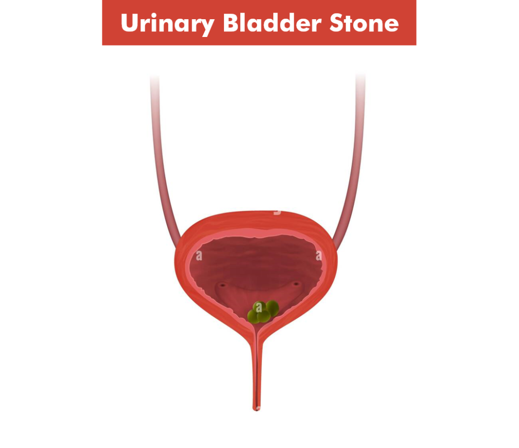 Urinary Bladder Stone