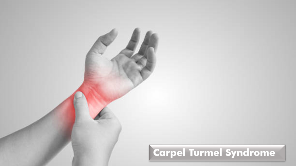 Carpel Turmel Syndrome