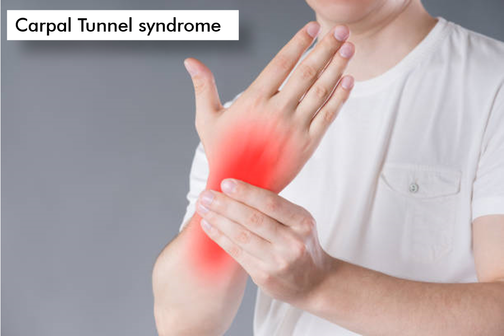 Carpel Turmel Syndrome