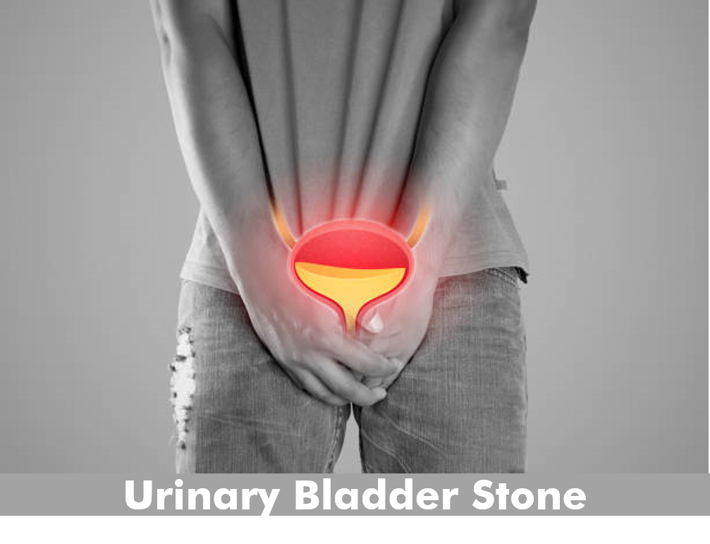 Urinary Bladder Stone