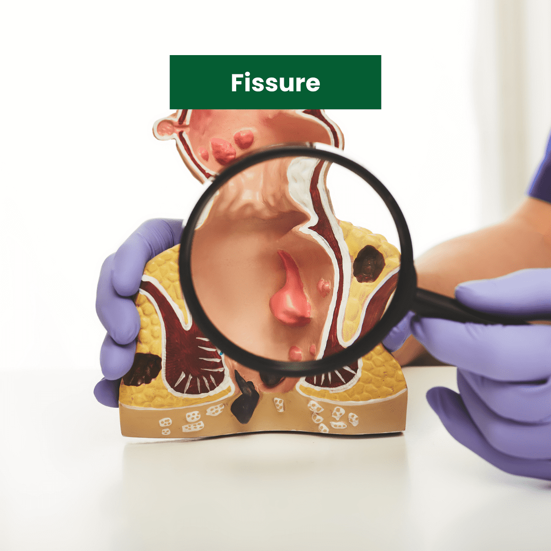 Fissure treatment in delhi