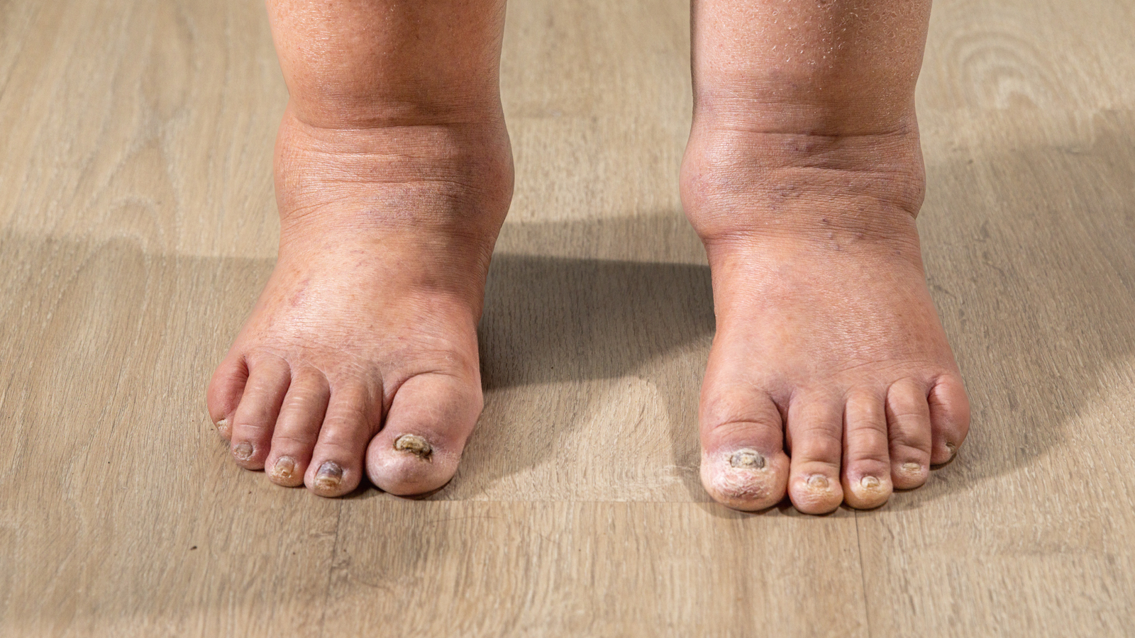 Swelling Problems: Types, Symptoms, Causes, and Treatments