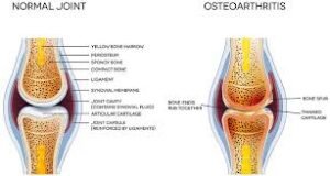 Understanding Osteoarthritis: An Ayurvedic Perspective