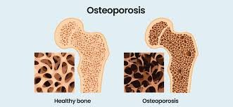 Understanding Osteoporosis: An Ayurvedic Perspective