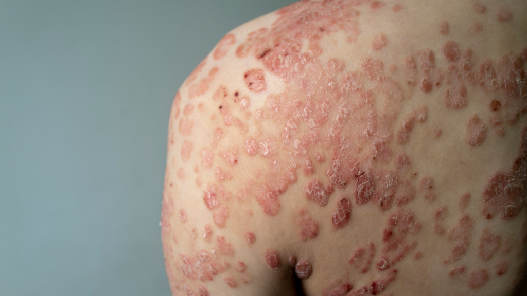 Psoriasis