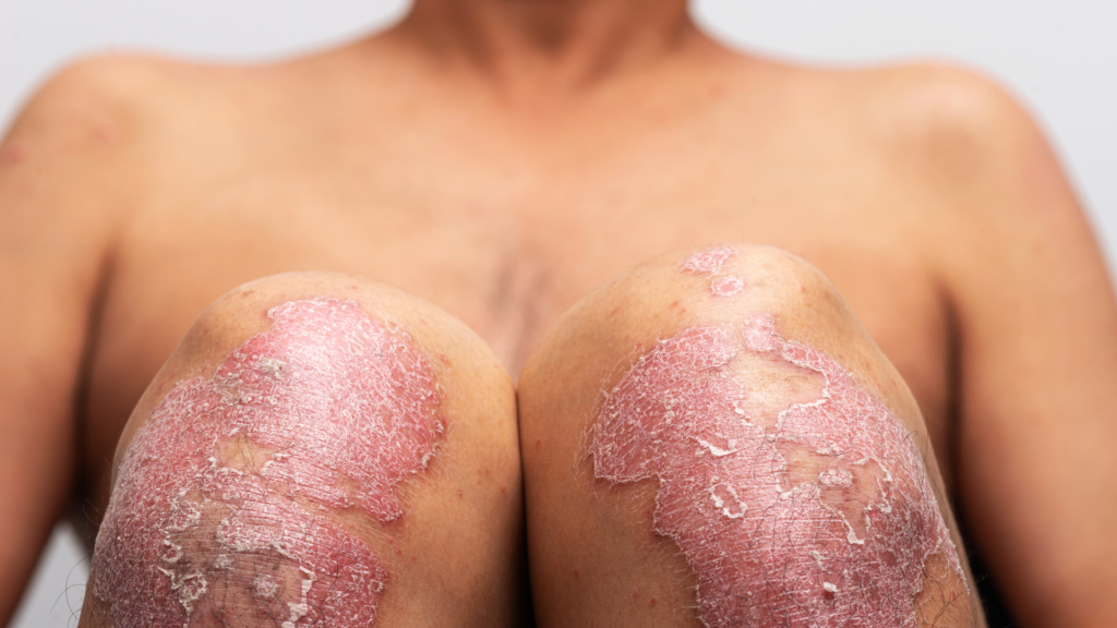 Psoriasis