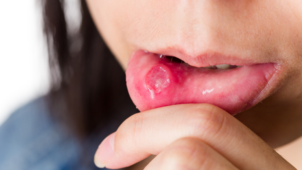 Ulcer Treatment
