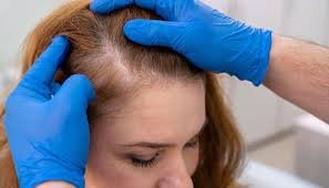 Treating Hair Loss